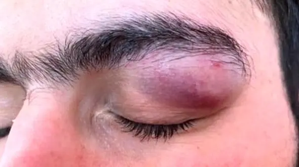 حمله با چاقو به چشمان یک پزشک در بندرعباس + عکس تلخ