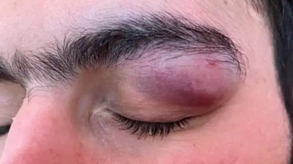 حمله با چاقو به چشمان یک پزشک در بندرعباس + عکس تلخ