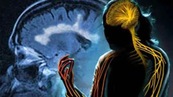 رابطه بیماری ام اس با استرس/این بیماری در زنان شایع تر است