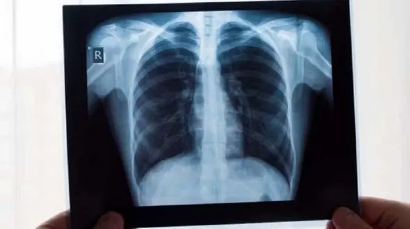 راه درمان شکستگی دنده