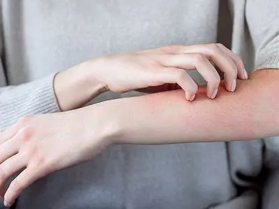 آلرژی؛ بیماری مزمن با یک درمان هدفمند / پاسخ به سوالات کاربران + جدول