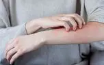 آلرژی؛ بیماری مزمن با یک درمان هدفمند / پاسخ به سوالات کاربران + جدول