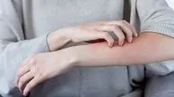 آلرژی؛ بیماری مزمن با یک درمان هدفمند / پاسخ به سوالات کاربران + جدول