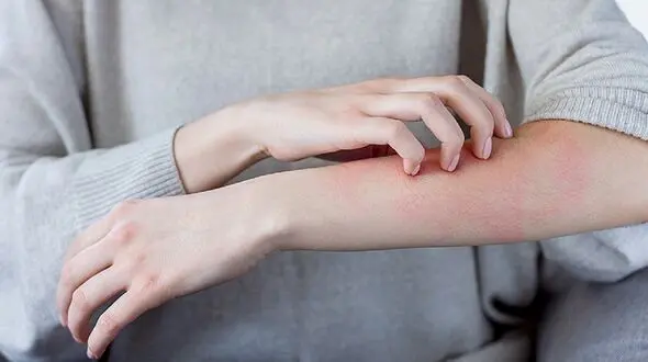 آلرژی؛ بیماری مزمن با یک درمان هدفمند / پاسخ به سوالات کاربران + جدول