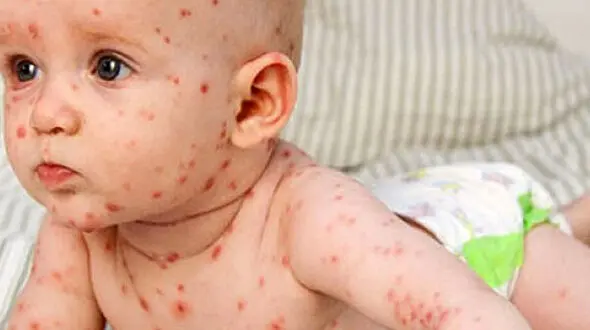 خطرات آبله مرغان برای زنان باردار