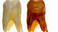 کشف دندان باستانی با سه ریشه +عکس 