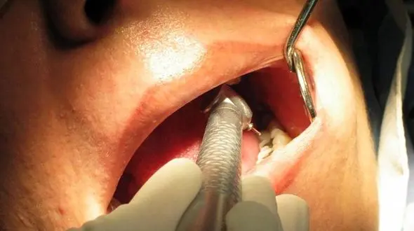 آیا هر دندان دردی نشانه پوسیدگی است؟ 