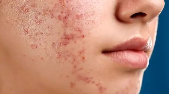 درمان آکنه با برچسب