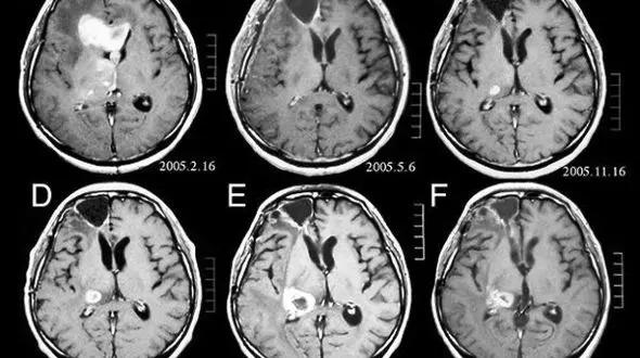 سی تی اسکن ریسک تومور مغزی را بالا می برد