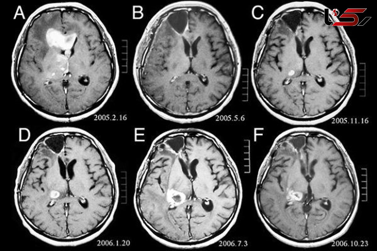 سی تی اسکن ریسک تومور مغزی را بالا می برد