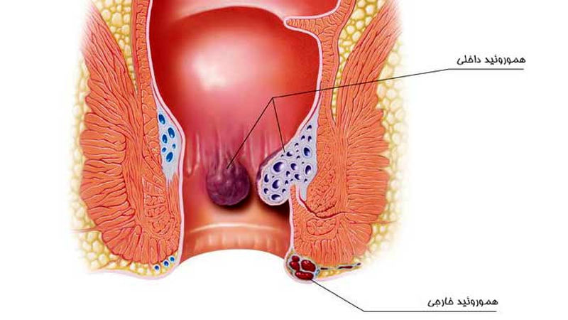 هموروئید