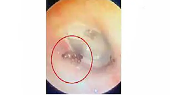 مورچه ای در گوش یک مرد + عکس