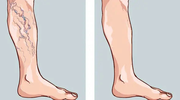 درمان خانگی و بی خطر واریس + فیلم