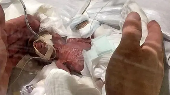 زنده ماندن معجزه آسای نوزاد 400 گرمی+ تصاویر
