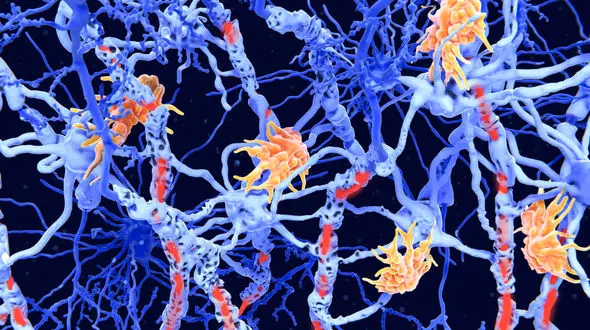 محققان 2 زیرنوع جدید از ام‌ اس را کشف کردند؛ پیشرفتی هیجان‌ انگیز