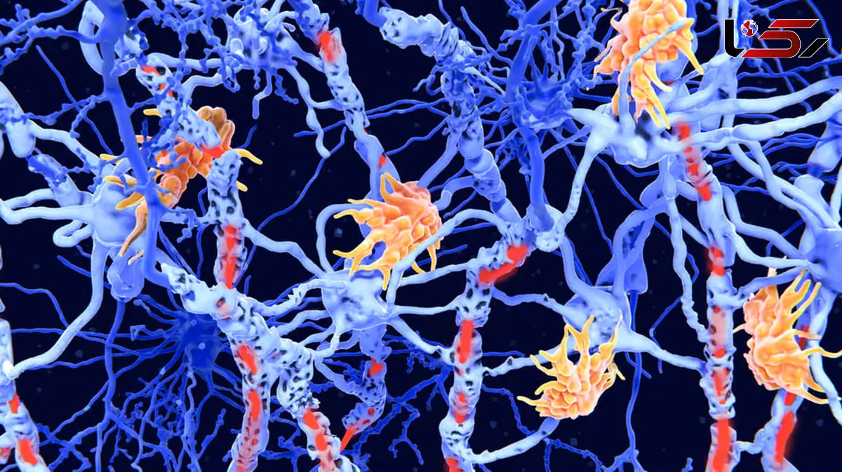 محققان 2 زیرنوع جدید از ام‌ اس را کشف کردند؛ پیشرفتی هیجان‌ انگیز