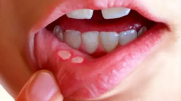 درمان آفت دهان با روش های خانگی و گیاهی +عکس