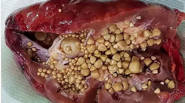 سنگ شکن کلیه چه عوارضی دارد؟