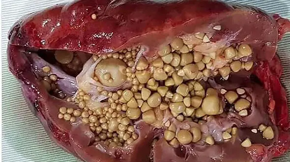 سنگ شکن کلیه چه عوارضی دارد؟