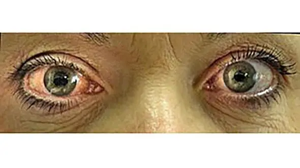 آب سیاه منجر به کوری می شود/ لزوم غربالگری و شناسایی کودکان مبتلا