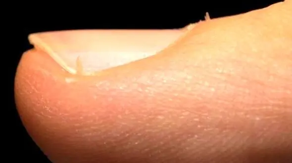 علل بروز ریشه کنار ناخن / راهکار درمان 