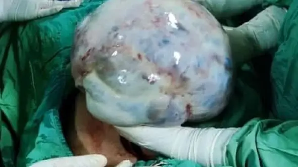 توده ۸ کیلویی از شکم بیمار اردبیلی خارج شد