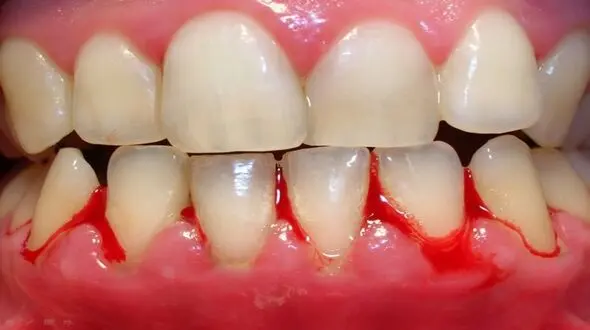 ارتباط دیابت و سکته مغزی با التهاب لثه