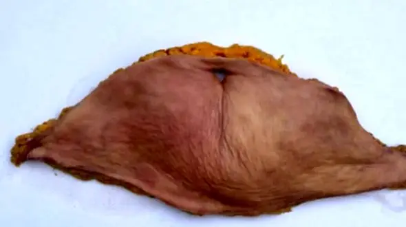 تصاویر باورنکردنی: زنی که پوست شکمش را به چرم انسانی تبدیل کرد!