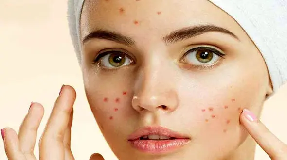 استرس عامل اصلی جوش صورت