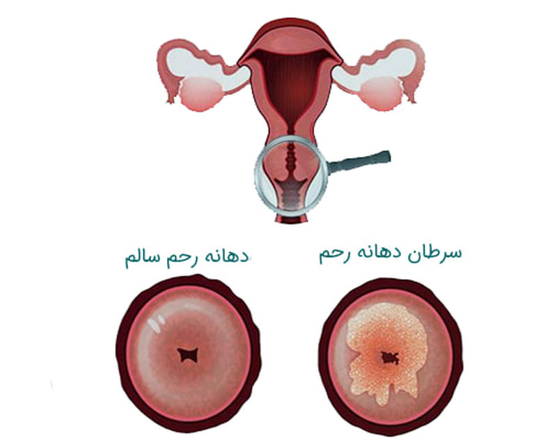 سرطان رحم چیست