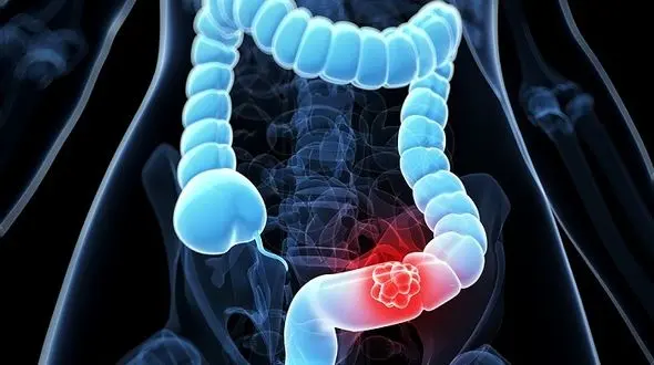 سرطان کولورکتال را جدی بگیرید