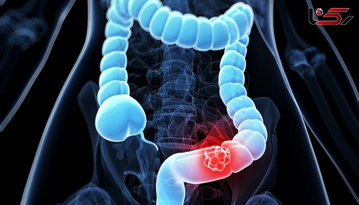 سرطان کولورکتال را جدی بگیرید
