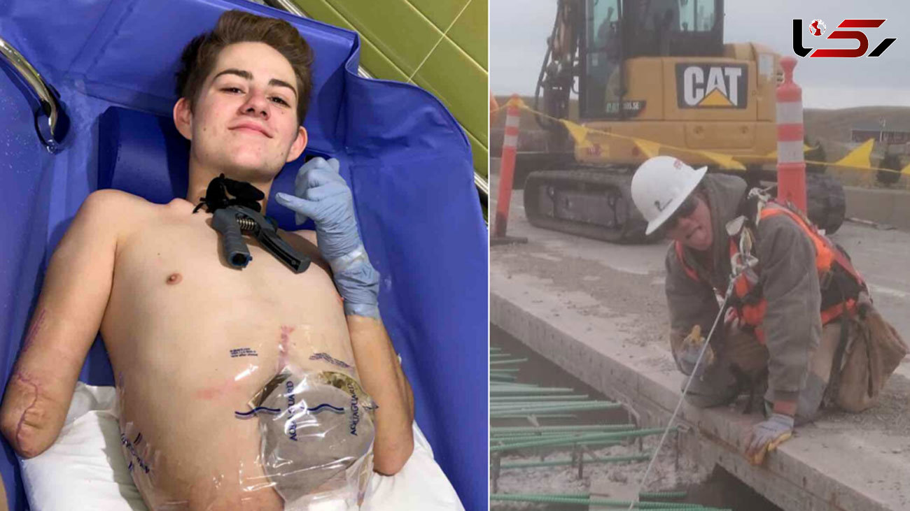 Teen crushed by forklift chooses to have half his body amputated so he