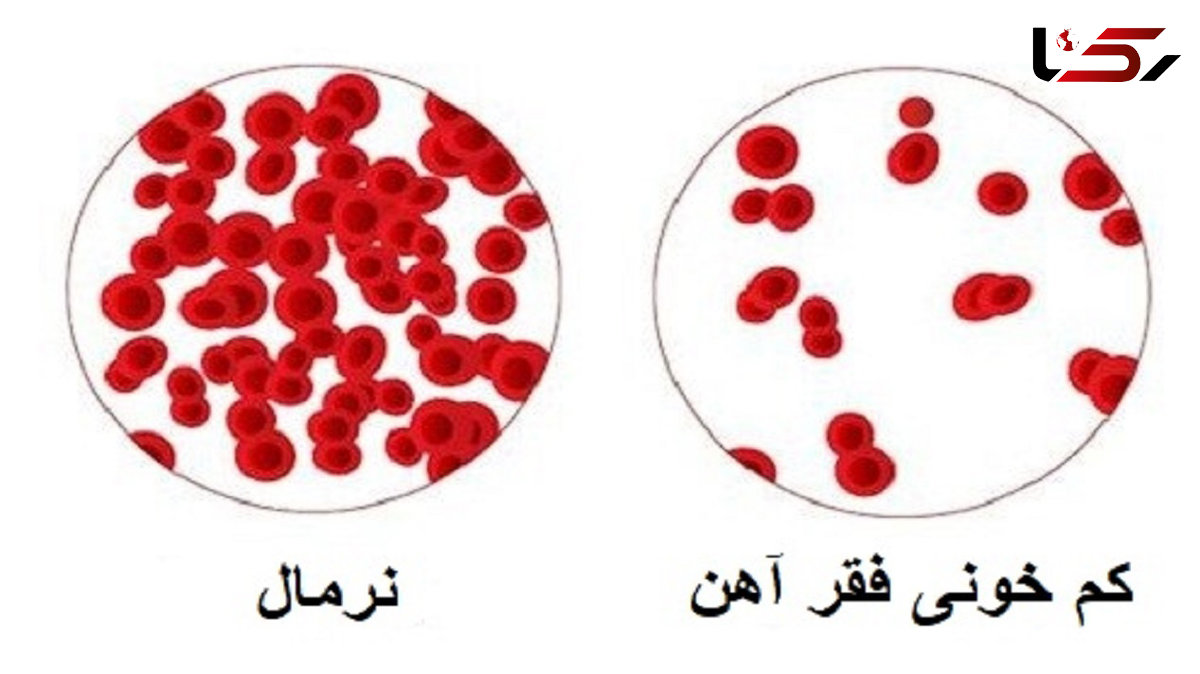 3 نشانه بارز کمبود آهن در بدن 