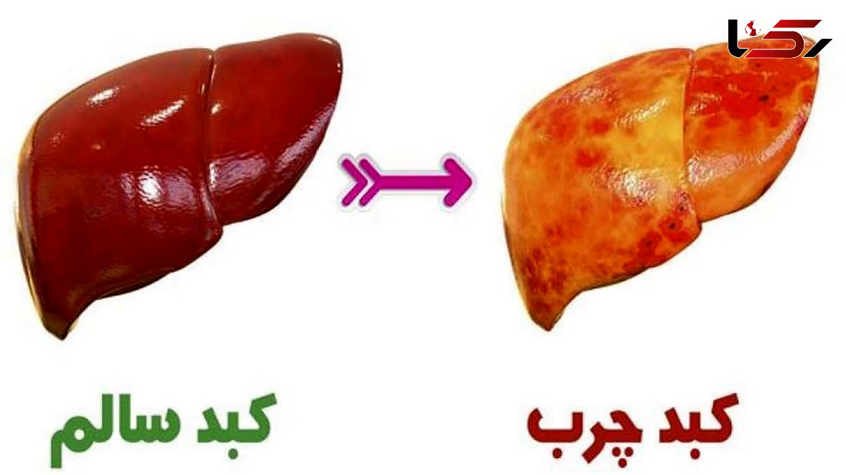 مهم ترین عوامل در کبد چرب 