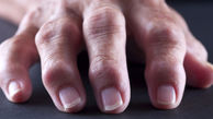 درد آرتروز انگشتان خود را چگونه کم کنیم؟