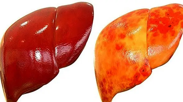 نشانه های بیماری کبدی چیست؟