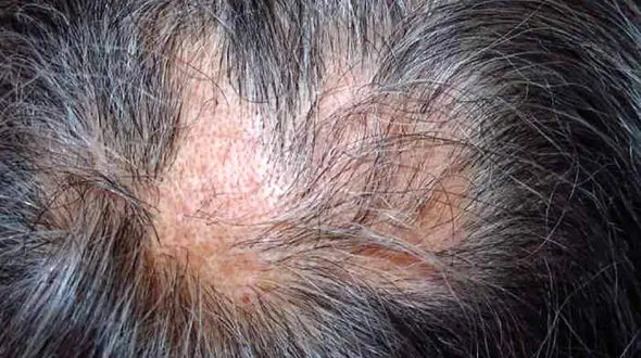 سرطان پوست سر؛ تهدیدی خاموش برای سلامت جهانی/از سرطان پوست سر چه می دانید؟