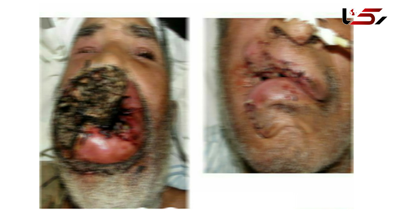 بیماری وحشتناک که به خاطر خوردن میوه های قاچاق بوجود می آید + عکس هولناک از یک بیمار در ساری(14+)