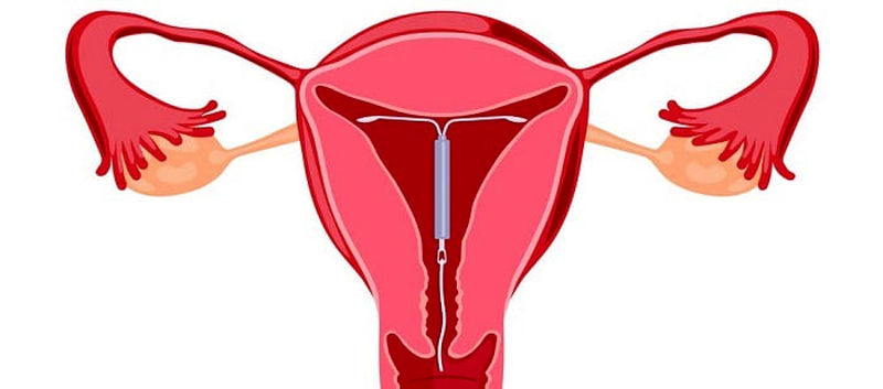 آی یو دی (IUD)