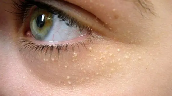 بهترین درمان های گیاهی برای رفع غده های چربی زیر پوست