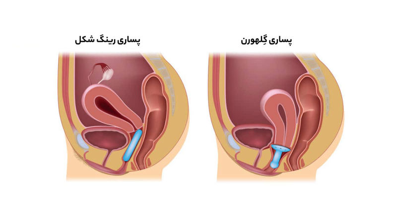 انواع پساری