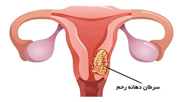 سرویکس چیست؟