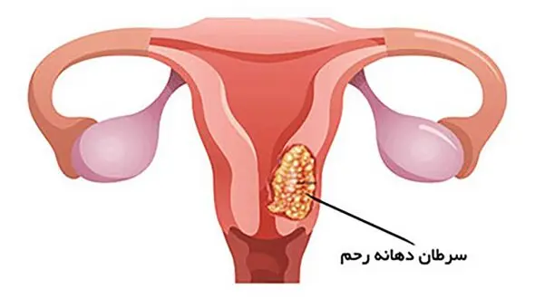سرویکس چیست؟