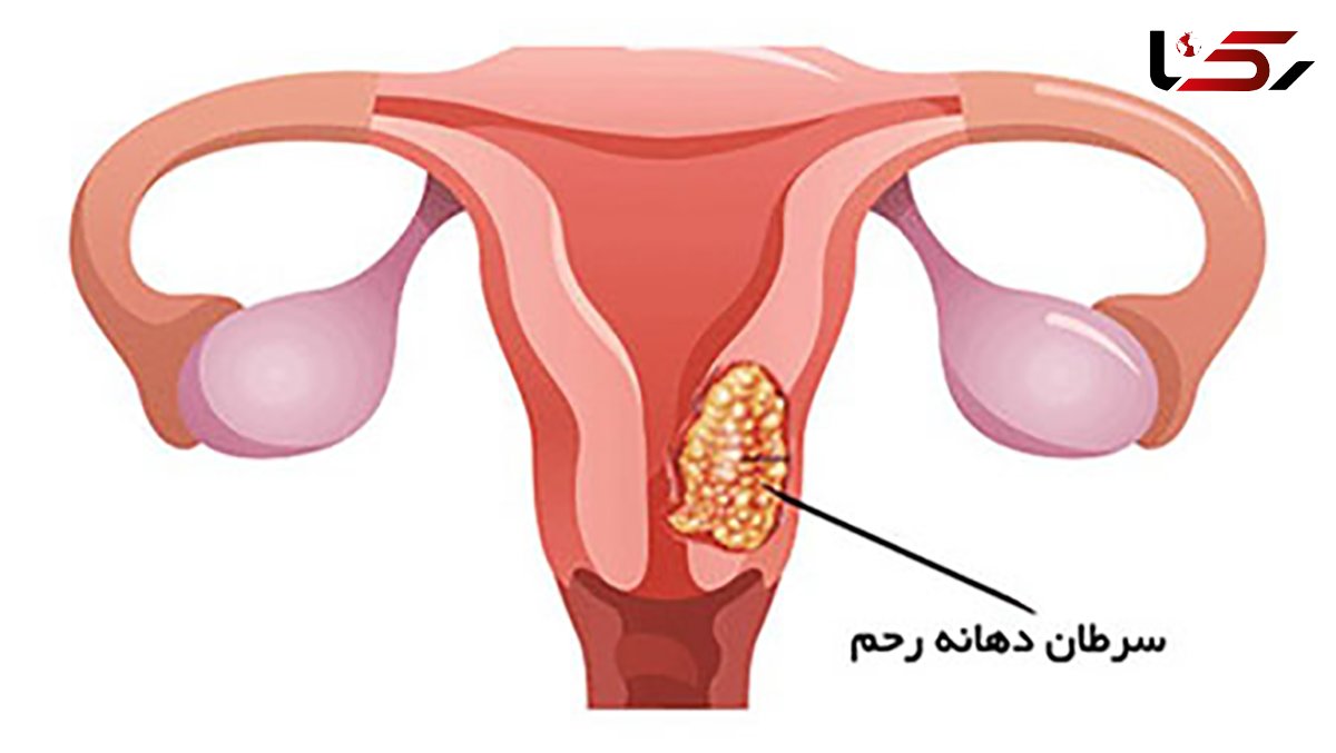 سرویکس چیست؟