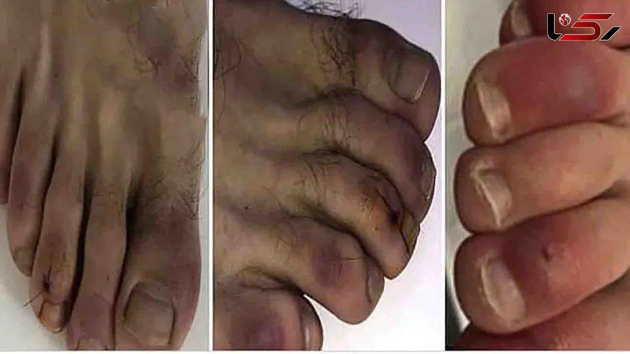 جدیدترین علامت کرونا این بار در انگشتان + عکس 