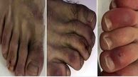 'Covid toes' that turn purple from the disease can last for FIVE MONTHS after survivors beat the infection, scientists claim