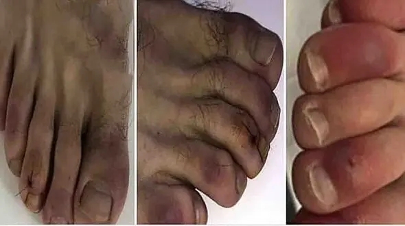 جدیدترین علامت کرونا این بار در انگشتان + عکس 