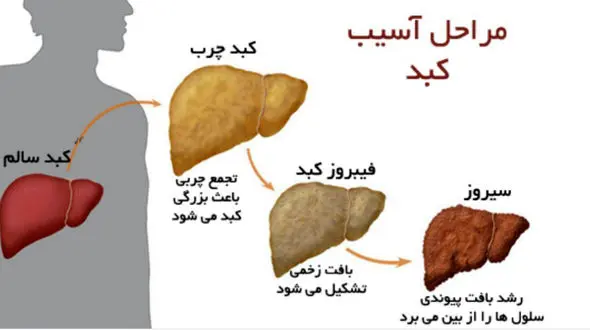 چطور از سکته قلبی و کبد چرب پیشگیری کنیم؟