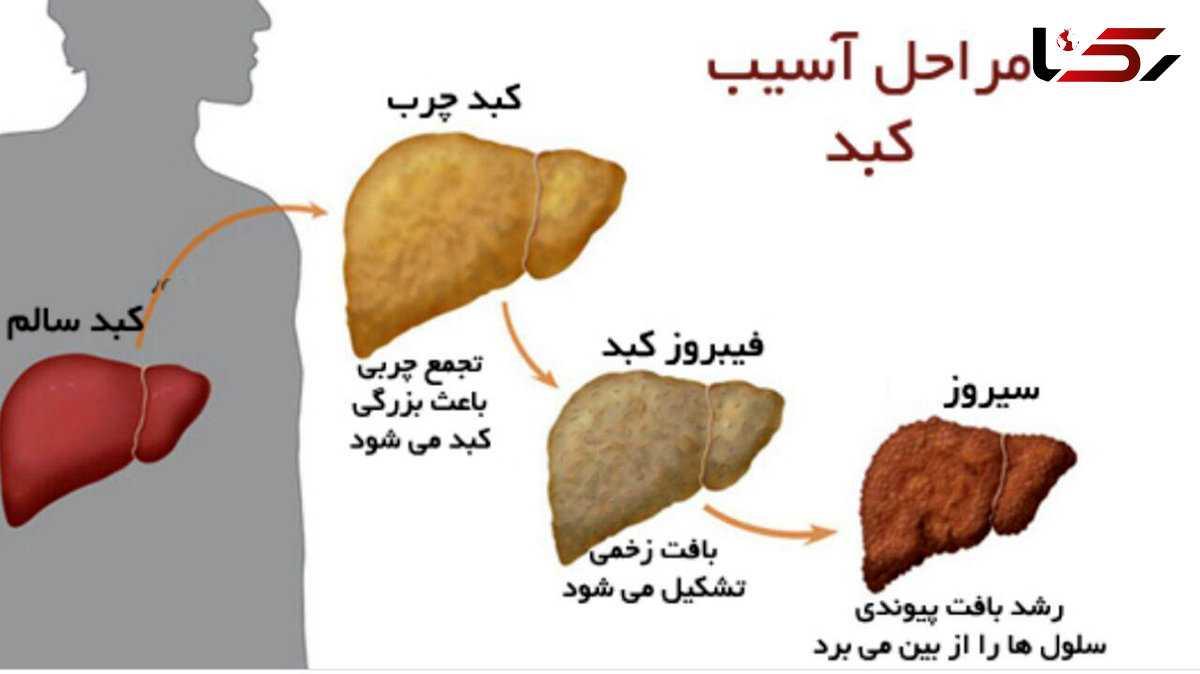 چطور از سکته قلبی و کبد چرب پیشگیری کنیم؟